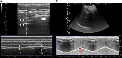 Point-of-care application of diaphragmatic ultrasonography in the emergency department for the prediction of development of respiratory failure in community-acquired pneumonia: A pilot study